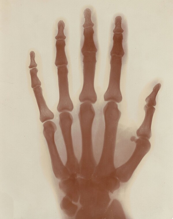 니콜라 테슬라가 자신의 고주파 자기공명 기술을 이용해 발생시킨 X-ray로 촬영한 왼손 투영사진. 1896년 독일 뷔르츠부르크대학의 뢴트겐이 X-ray 사진을 발표하자 테슬라는 그보다 먼저 찍은, 더욱 선명한 자신의 사진을 뢴트겐에게 보내주었다. 1900년 전후 쏟아져 나온 신세기적 발명품들 가운데는 테슬라의 원천기술을 이용한 것들이 많다. 퍼블릭도메인